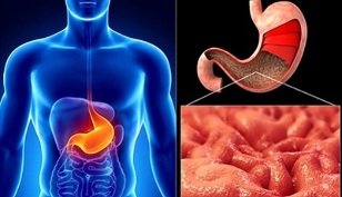 nutritional rules for gastritis