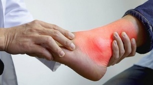 what you can and cannot eat with gout on your legs
